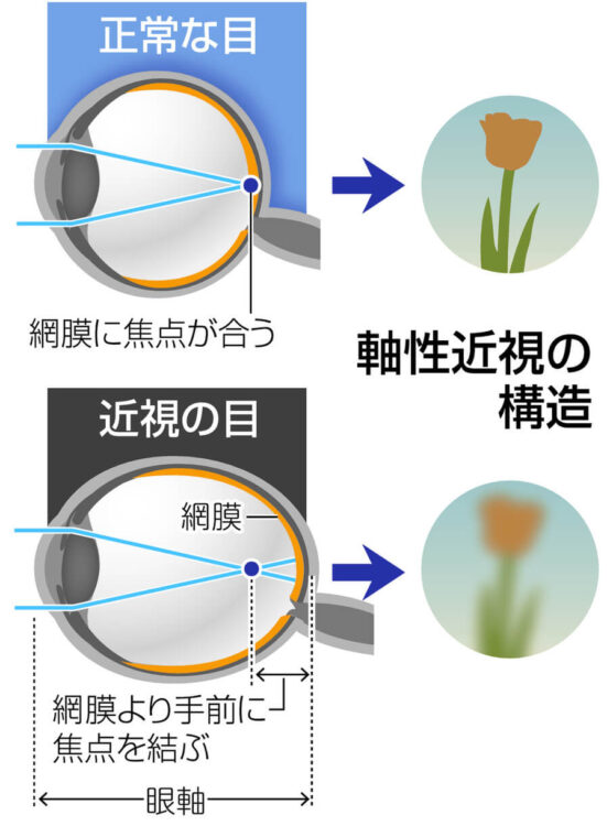 近視をあらわした図